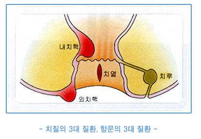 치질의 3대질환, 항문의 3대질환